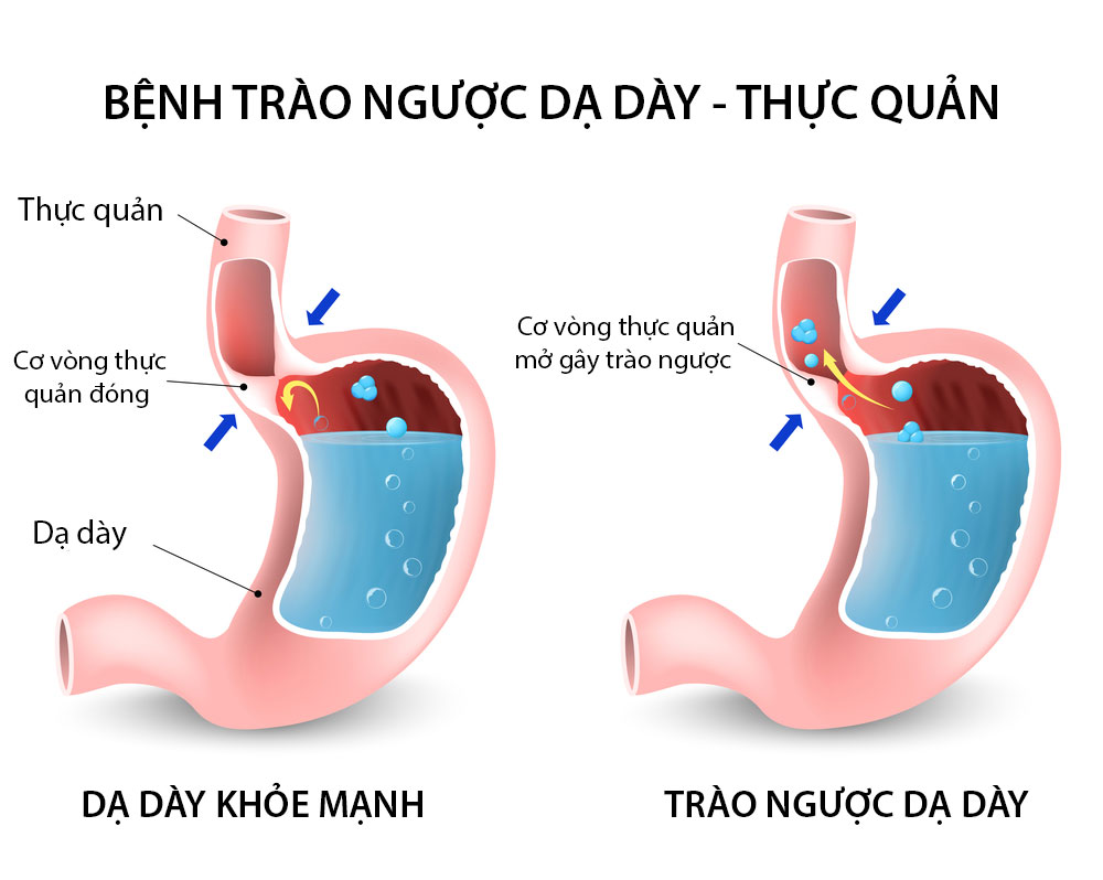 Những nguyên tắc nào cần tuân thủ trong việc phòng ngừa trào ngược dạ dày thực quản?