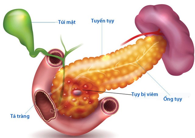 Thời gian điều trị viêm tụy cấp bỏ y tế bao lâu?
