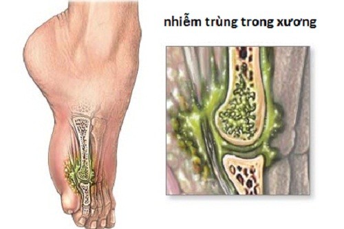 Thời gian điều trị viêm khớp nhiễm trùng là bao lâu?
